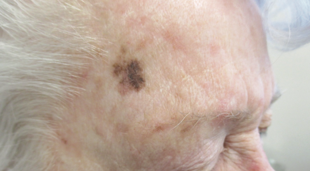 Can You Identify This Asymptomatic Lesion on an Elderly Man’s Temple
